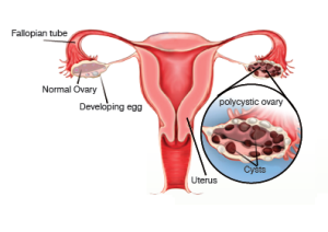 polycystic-ovary1